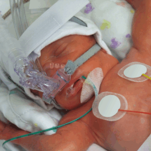 étude sur le peau à peau en prématurité